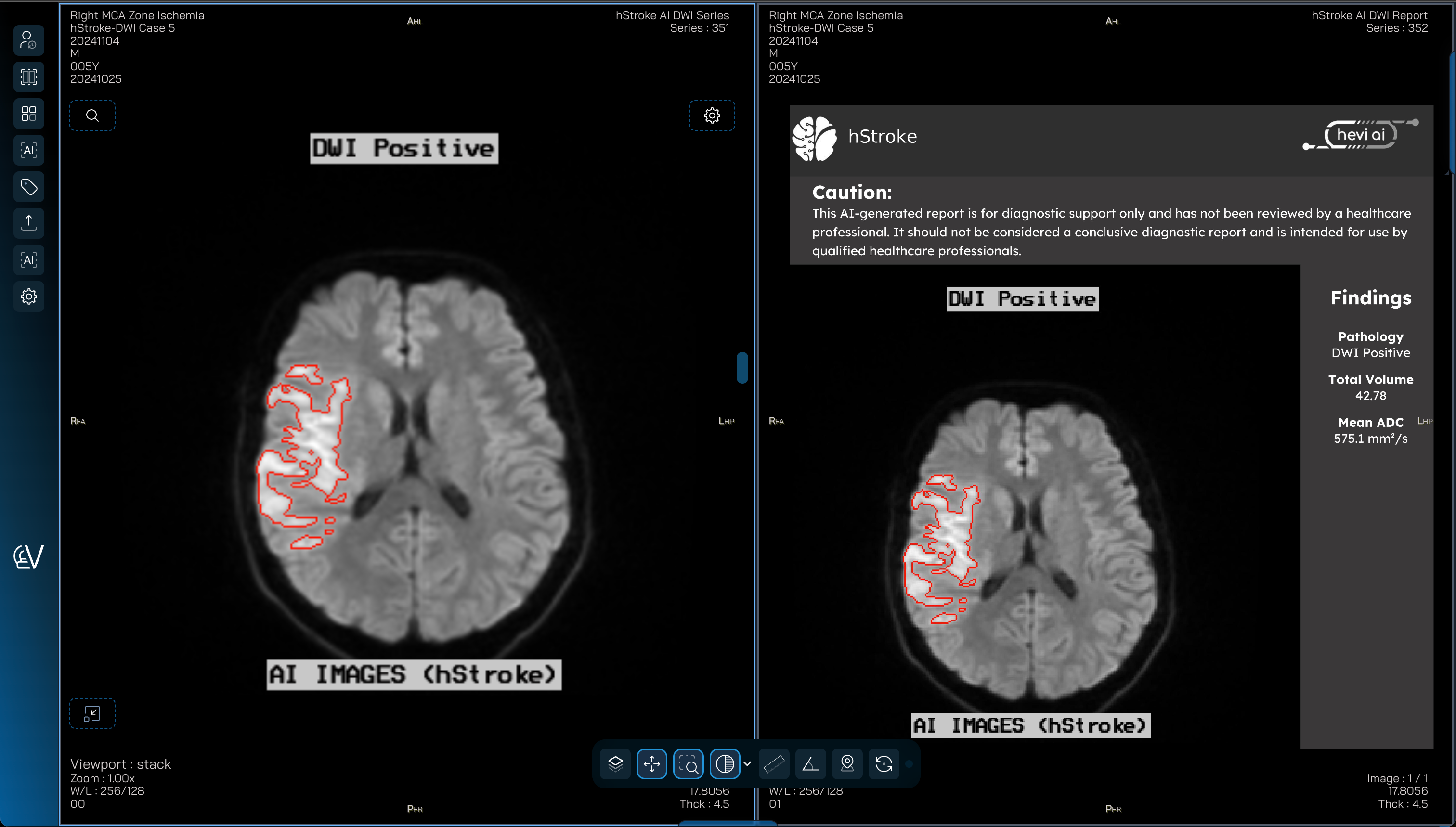 Hevi AI – hStroke_Suite