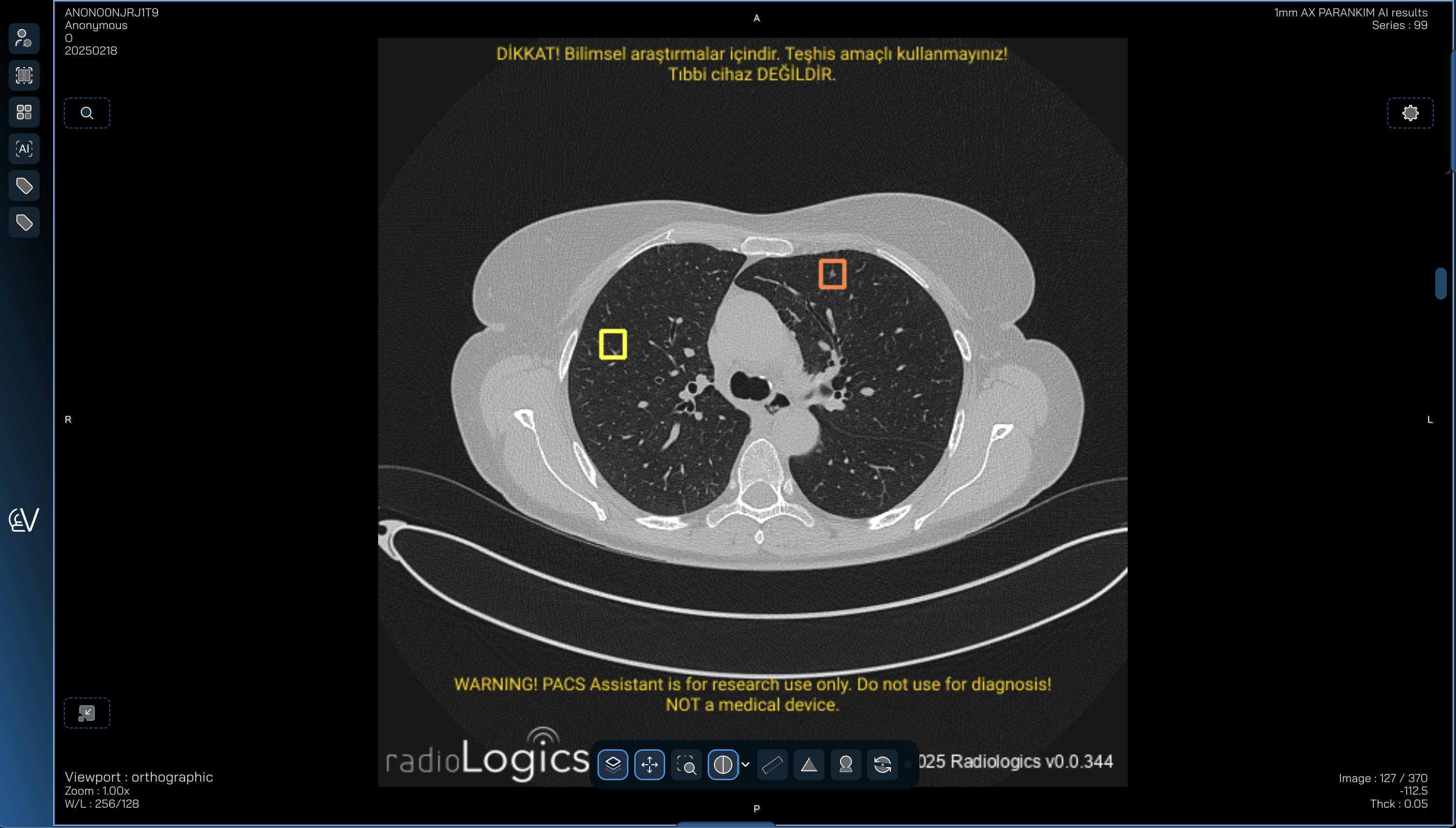 PACS ASSISTANT LUNG NODULES